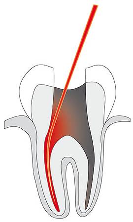 Bild Endodontie / © Cumdente Bild Endodontie / © Cumdente